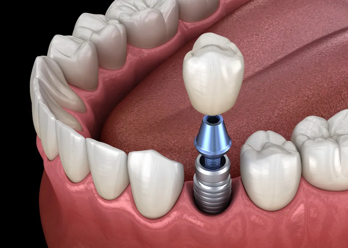 Prosthodontics